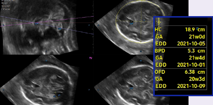 5d ultrasound : 5D CNS+™